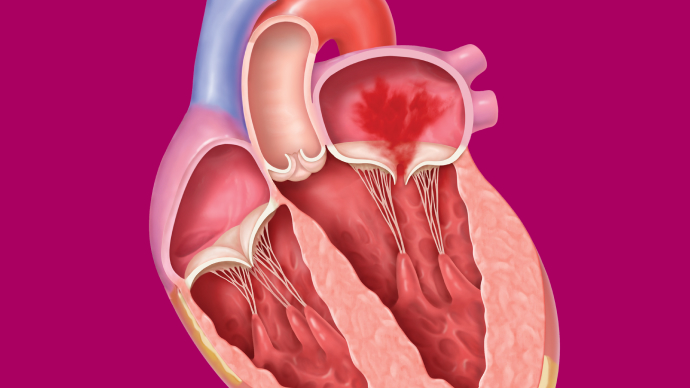 Understanding mitral regurgitation video