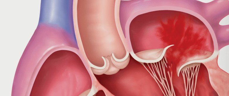 Primary mitral regurgitation